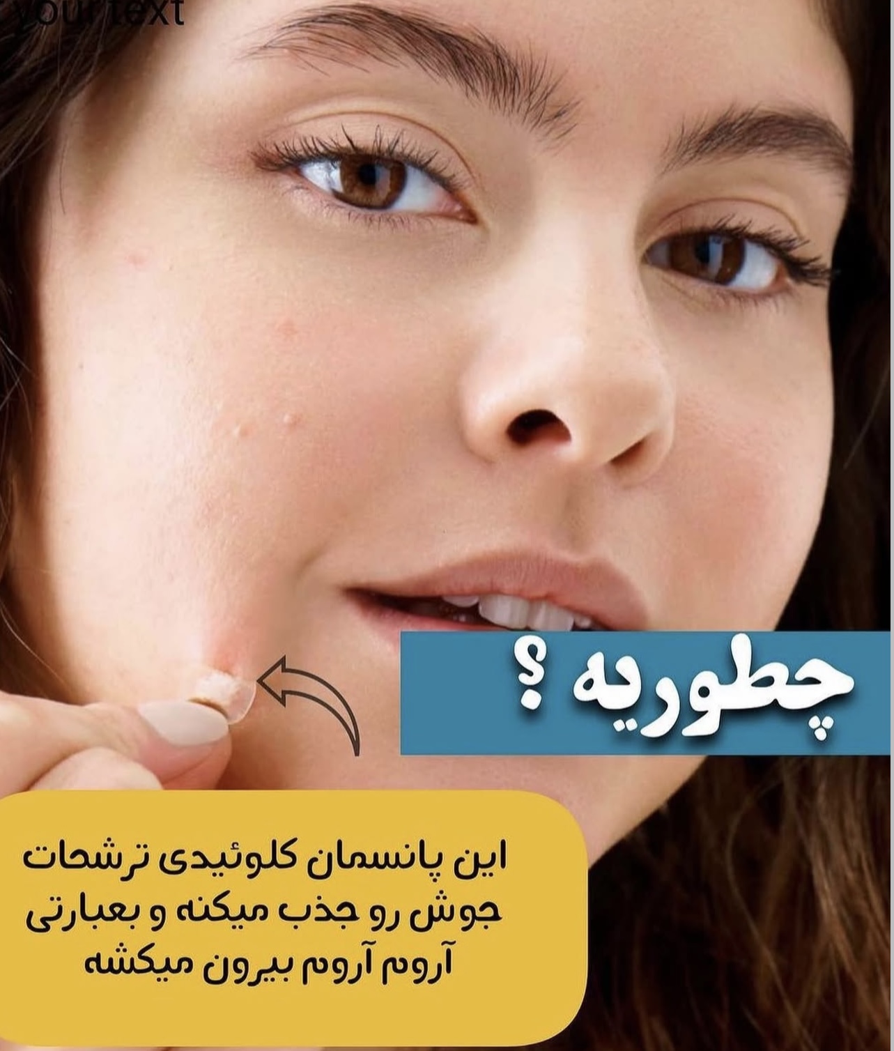 چسب ضد جوش